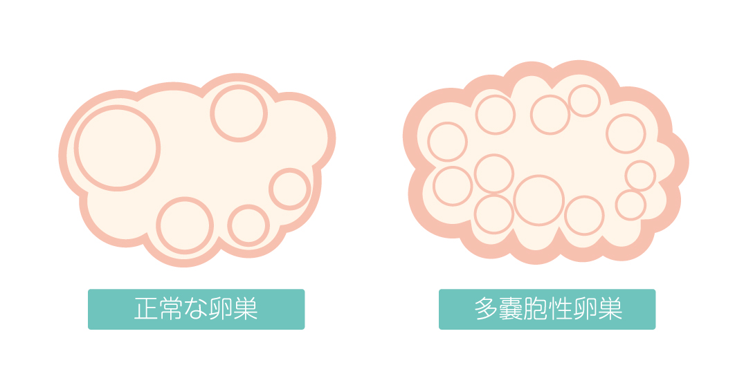 子宮内膜症またはPCOSについて医師の診察を受ける時期