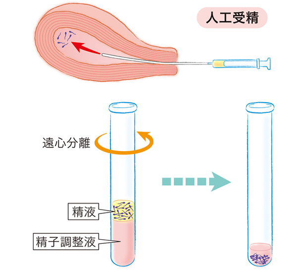 人工授精：AIH　(子宮内精子注入法)